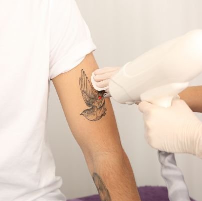 Tattoo Removal